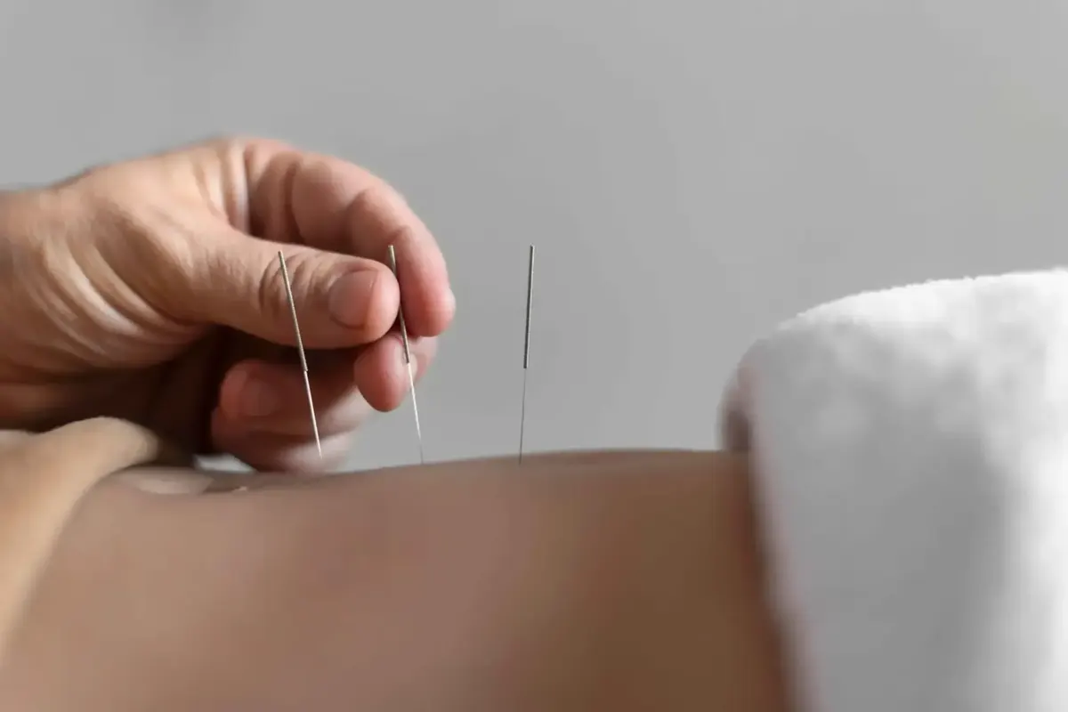 Dry needles placed in the back of a patient’s shoulder