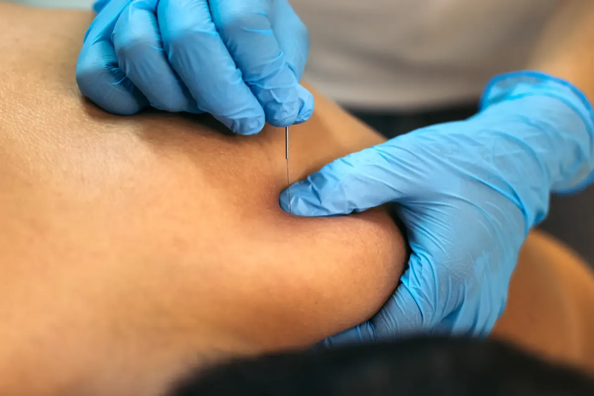 Gloved hands placing a dry needle in a tight muscle